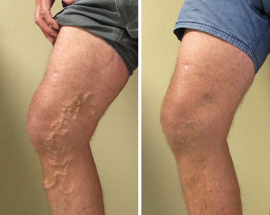 Experiencia del uso de gel zxcvbnmqwert