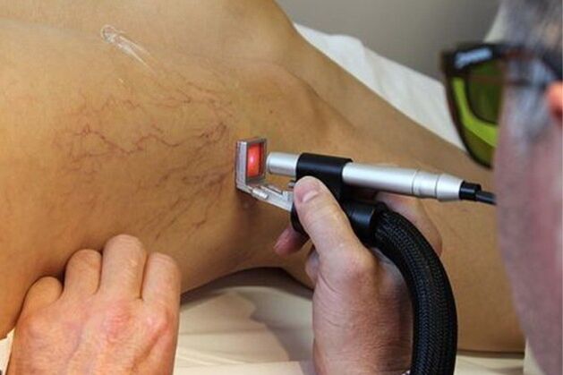 Tratamiento con láser de varices de las extremidades inferiores.