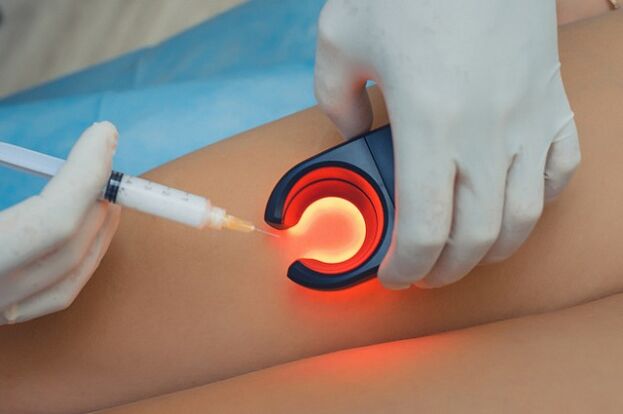 Tratamiento de las varices mediante escleroterapia.