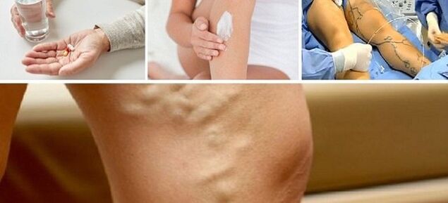 Tratamiento de las venas varicosas