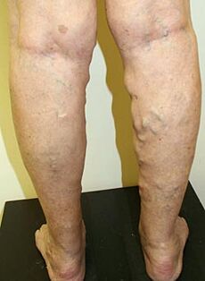 venas varicosas en las piernas