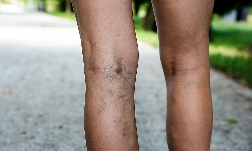 Venas expandidas en las piernas