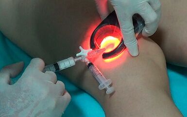 La escleroterapia como una forma de tratar las venas varicosas en las piernas