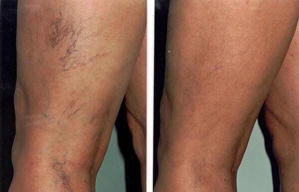 Fotos antes y después del tratamiento de varices.